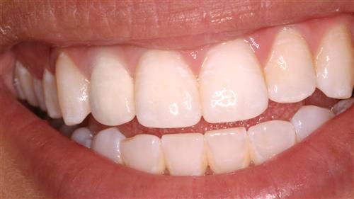 tooth whitening - after
