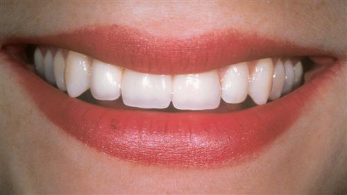 tooth whitening - after