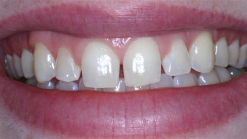 veneers- before