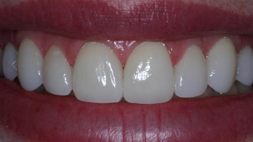 veneers- after