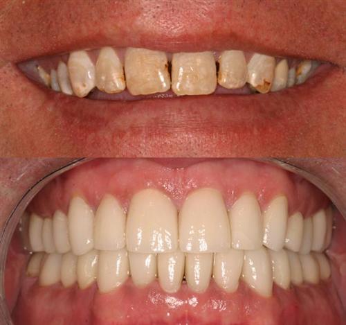 veneers- after