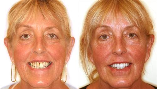 veneers- before