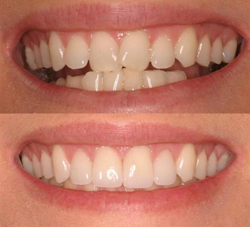 veneers- after