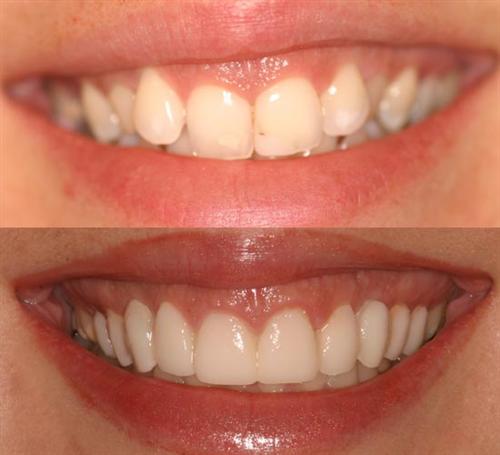 veneers- after