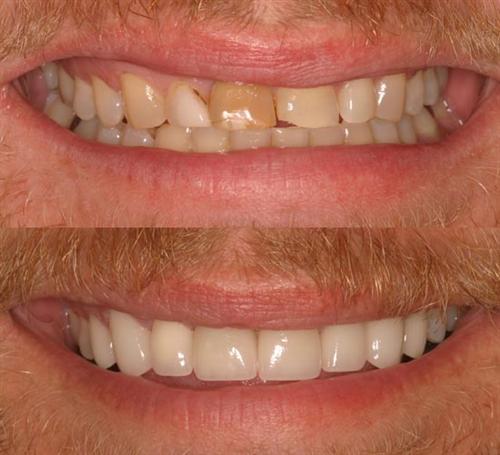 veneers- after