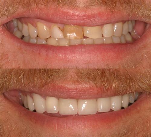 veneers- after