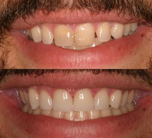 veneers- after