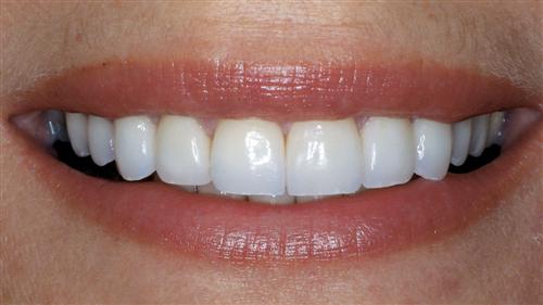 veneers- after