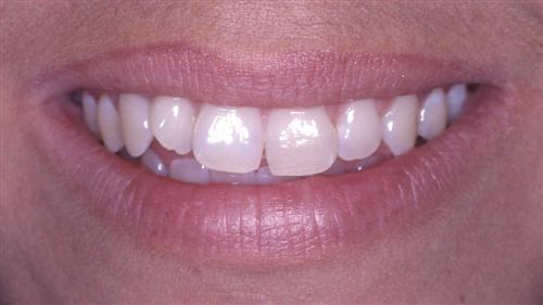 veneers- before