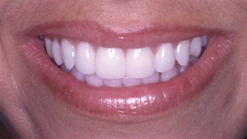 veneers- after