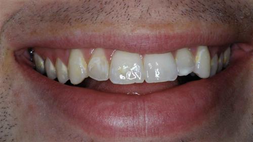 veneers- before