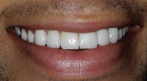 veneers- after