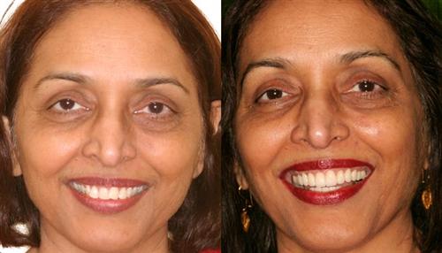 veneers- before