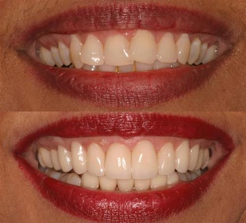 veneers- after