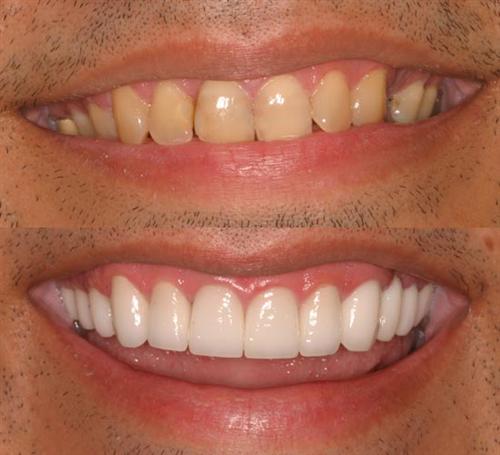 veneers- after