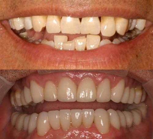 veneers- after