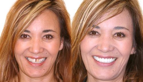 veneers- before