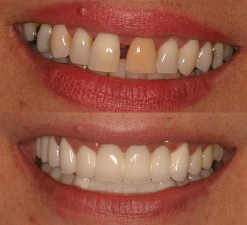 veneers- after