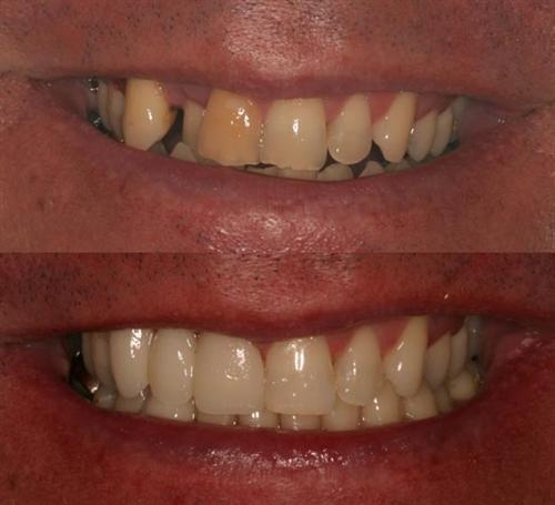 veneers- after