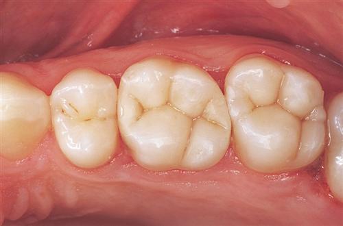 tooth colored fillings - after