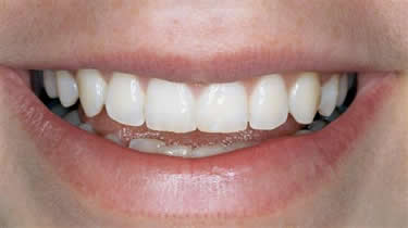 tooth whitening - before