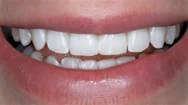 tooth whitening - after