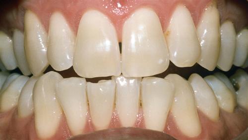 tooth whitening - before