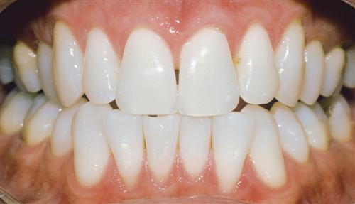 tooth whitening - after