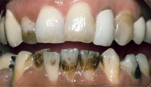 tooth whitening - before