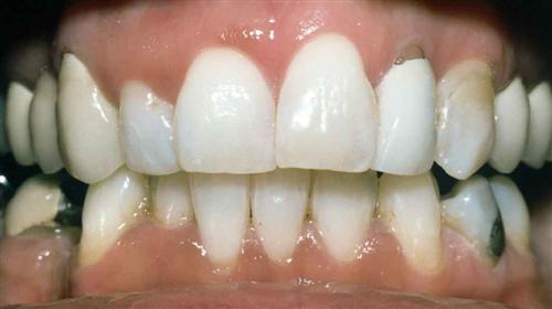 tooth whitening - after