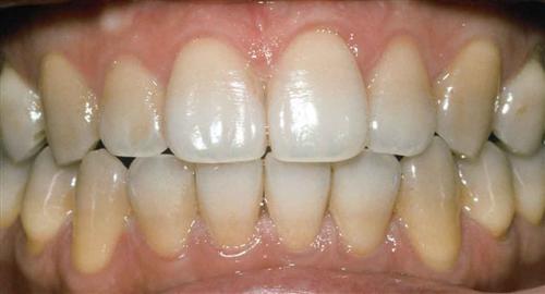 tooth whitening - before