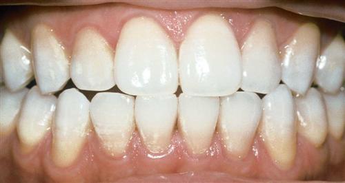 tooth whitening - after