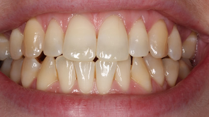 tooth whitening - before