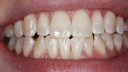 tooth whitening - after