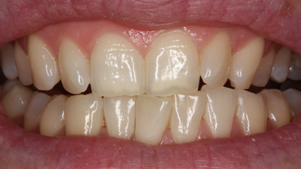 tooth whitening - before