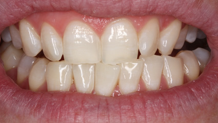 tooth whitening - after